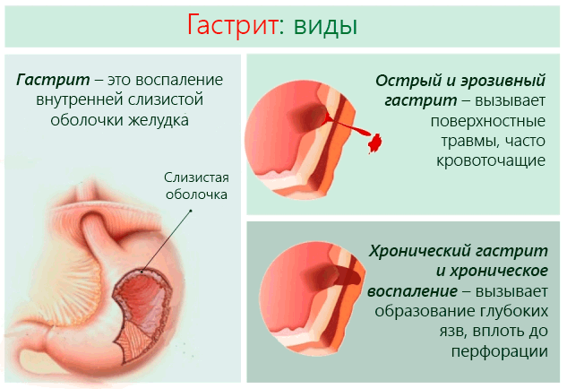 gastritis